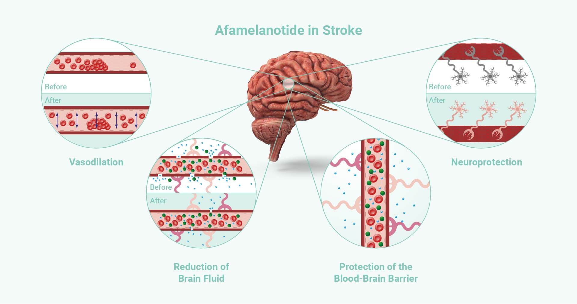 Graphic - Afamelanotide in Stroke