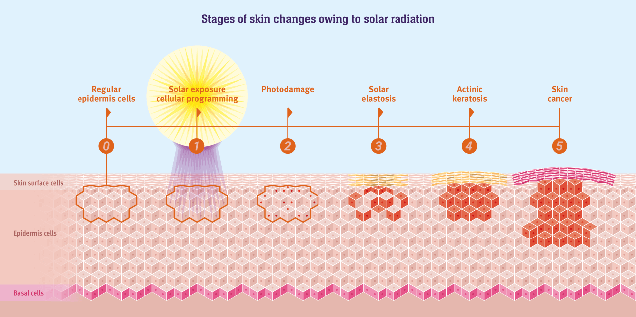 Diagram: Stages of skin cancer